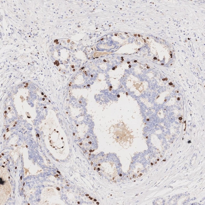 Immunohistochemistry (IHC) staining of human breast cancer tissue using Ki-67 Recombinant monoclonal antibody (84192-4-RR)