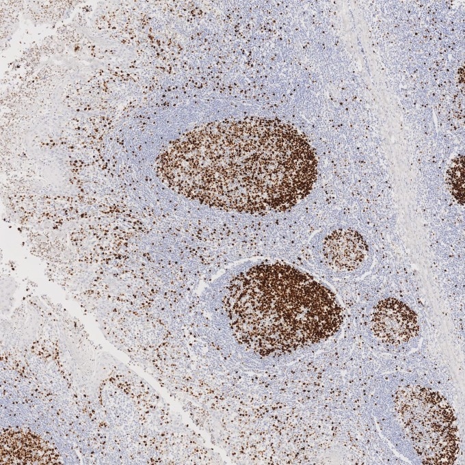 Immunohistochemistry (IHC) staining of human tonsillitis tissue using Ki-67 Recombinant monoclonal antibody (84192-4-RR)