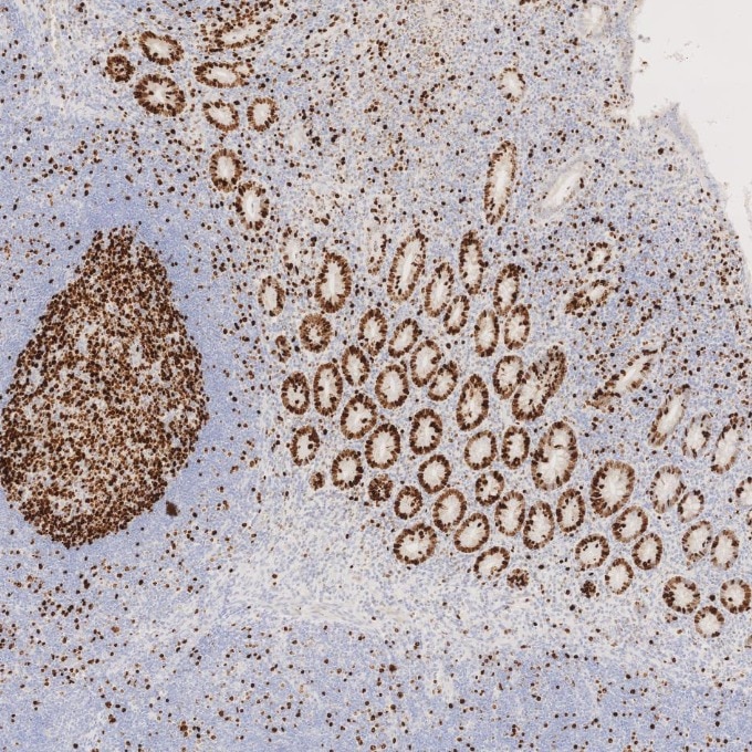 Immunohistochemistry (IHC) staining of human appendicitis tissue using Ki-67 Recombinant monoclonal antibody (84192-4-RR)