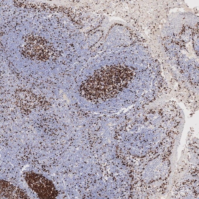 Immunohistochemistry (IHC) staining of human tonsillitis tissue using Ki-67 Recombinant monoclonal antibody (84192-4-RR)