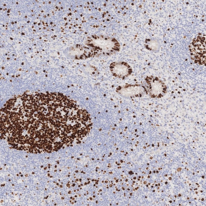 Immunohistochemistry (IHC) staining of human appendicitis tissue using Ki-67 Recombinant monoclonal antibody (84192-4-RR)