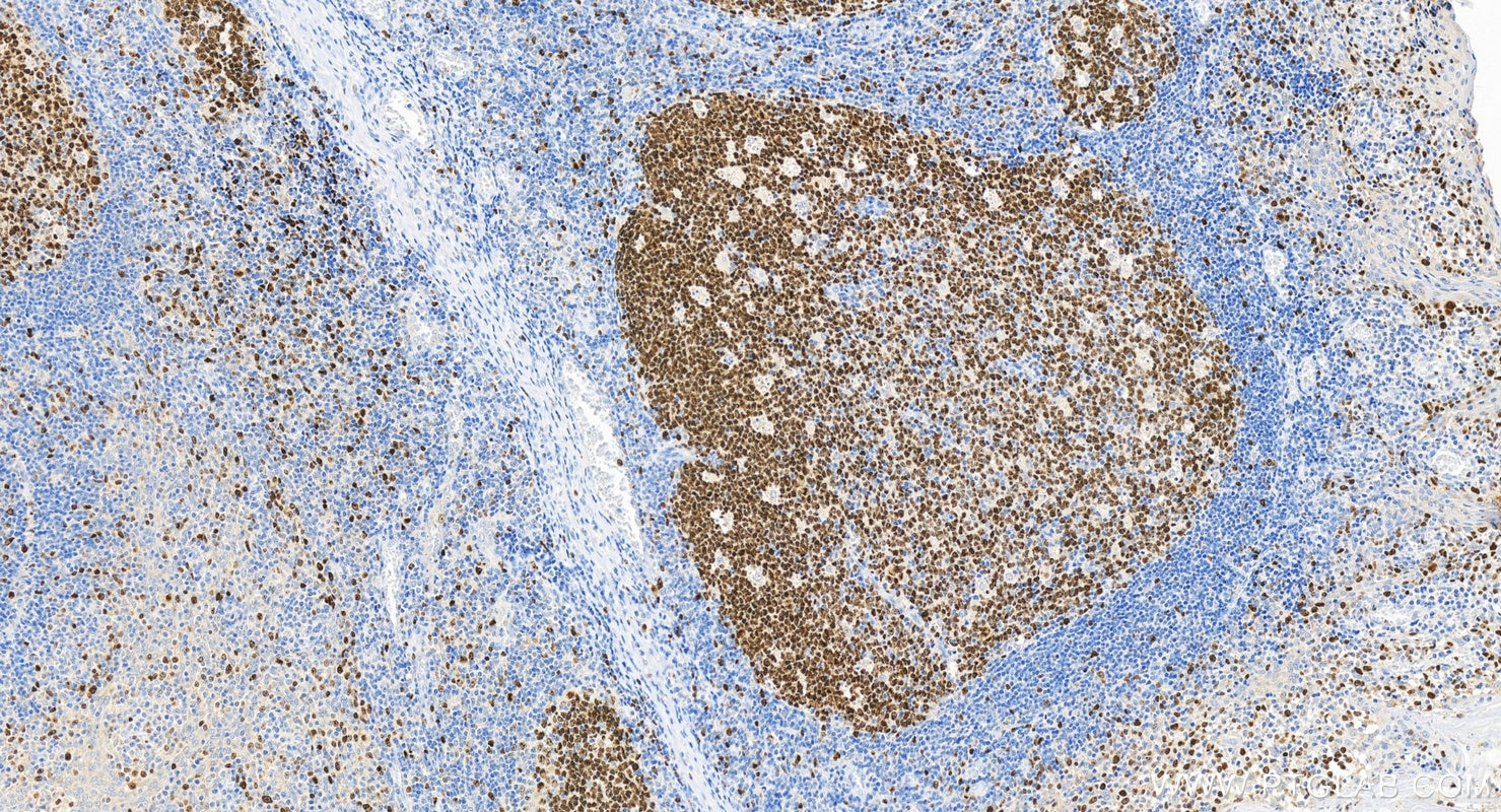 Immunohistochemistry (IHC) staining of human tonsillitis tissue using Biotin-conjugated Ki-67 Recombinant antibody (Biotin-84192-4)