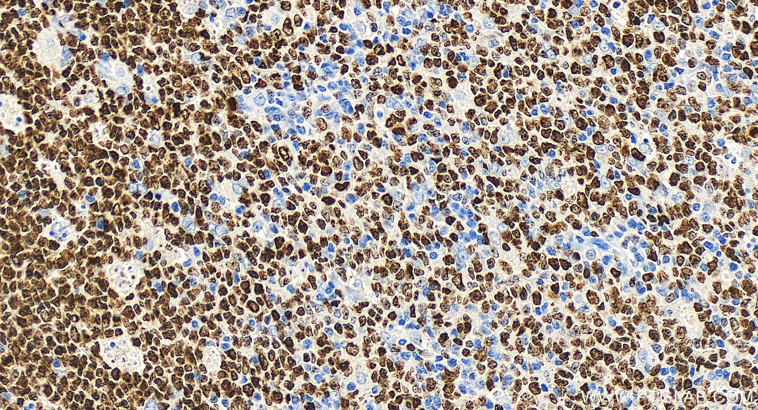 Immunohistochemistry (IHC) staining of human tonsillitis tissue using Biotin-conjugated Ki-67 Recombinant antibody (Biotin-84192-4)