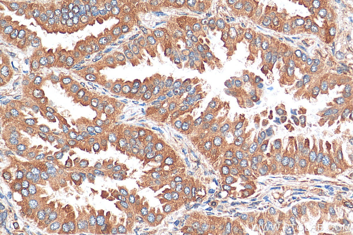 Immunohistochemistry (IHC) staining of human lung cancer tissue using Kindlin 2 Polyclonal antibody (29911-1-AP)