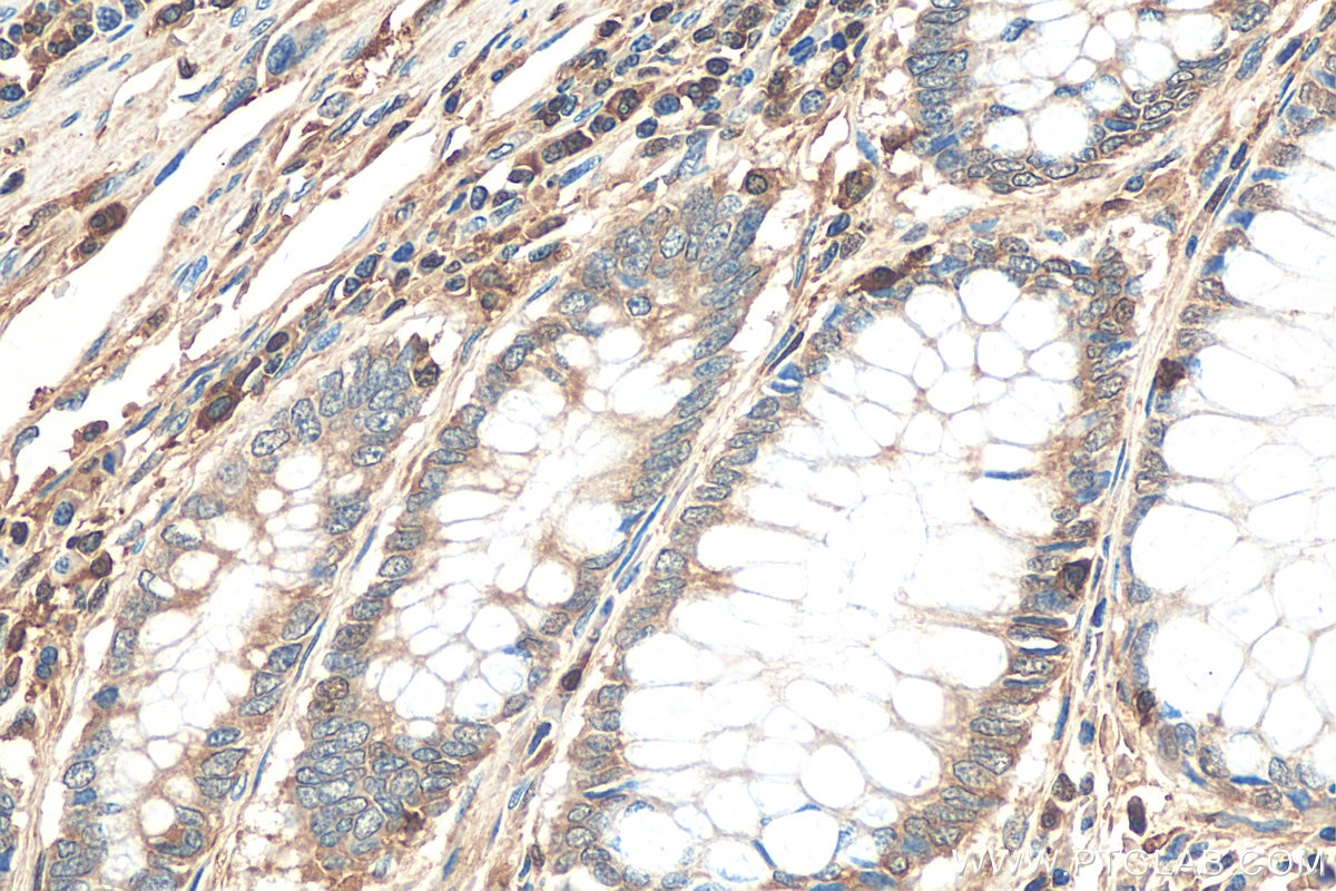 Immunohistochemistry (IHC) staining of human colon cancer tissue using L-Plastin Polyclonal antibody (55208-1-AP)