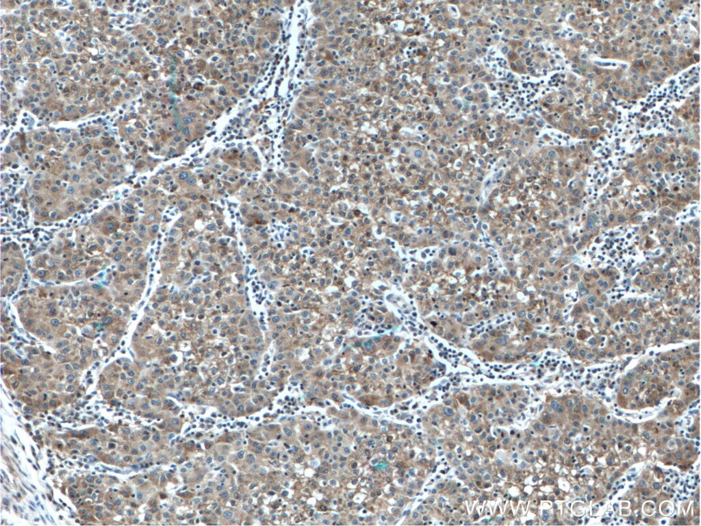 Immunohistochemistry (IHC) staining of human liver cancer tissue using L-VEGFA Polyclonal antibody (22341-1-AP)