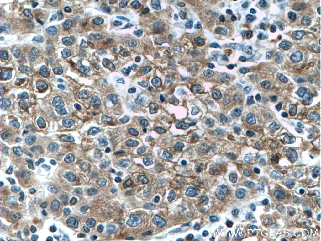 Immunohistochemistry (IHC) staining of human liver cancer tissue using L-VEGFA Polyclonal antibody (22341-1-AP)