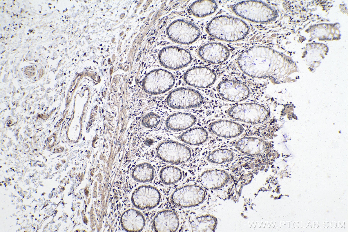 Immunohistochemistry (IHC) staining of human colon cancer tissue using L-VEGFA Polyclonal antibody (22341-1-AP)