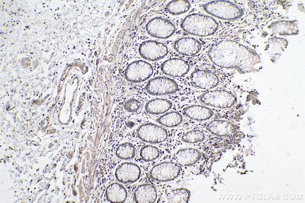 IHC staining of human colon cancer using 22341-1-AP