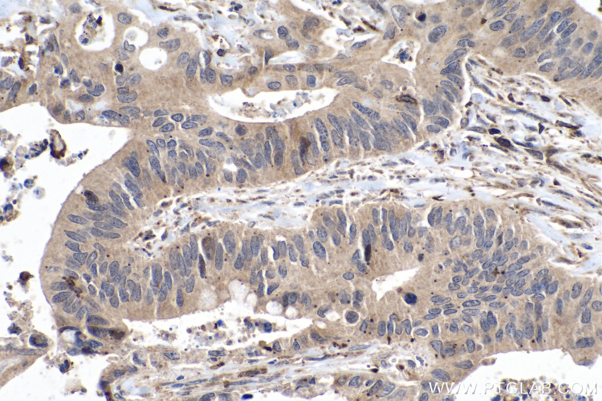 IHC staining of human colon cancer using 22341-1-AP