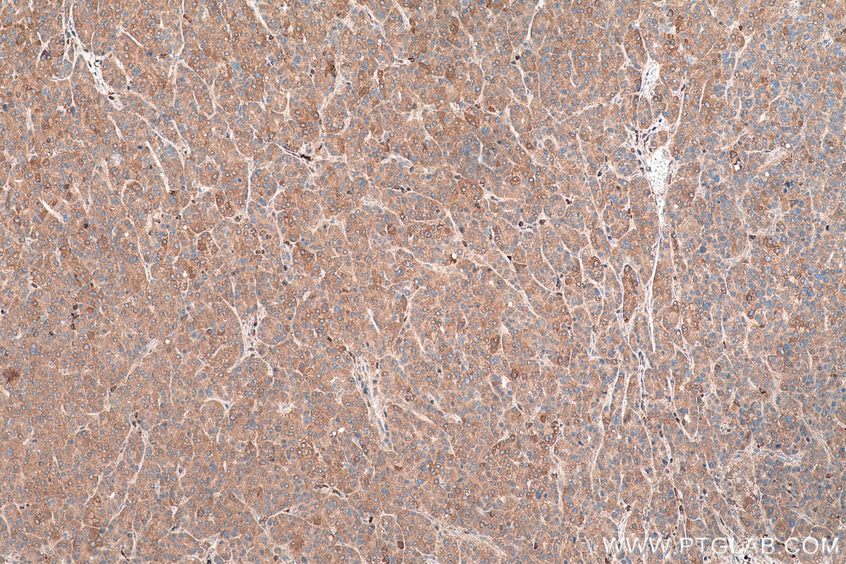 Immunohistochemistry (IHC) staining of human liver cancer tissue using L-VEGFA Polyclonal antibody (22341-1-AP)