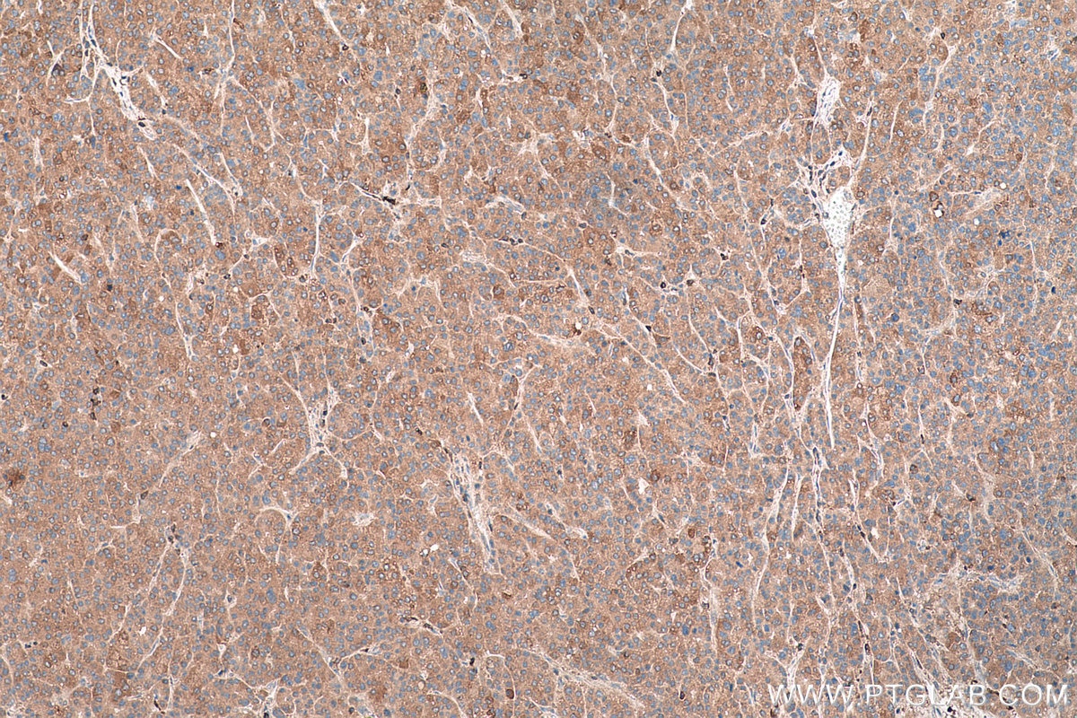 IHC staining of human liver cancer using 22341-1-AP