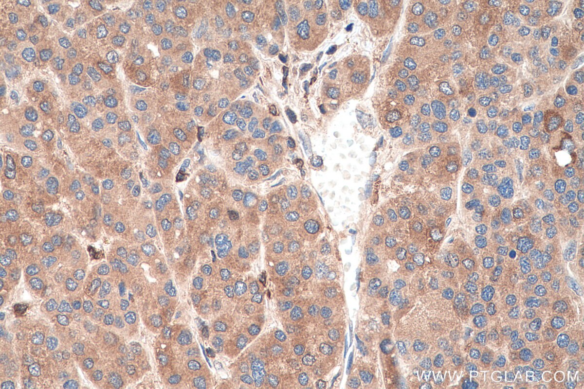 Immunohistochemistry (IHC) staining of human liver cancer tissue using L-VEGFA Polyclonal antibody (22341-1-AP)