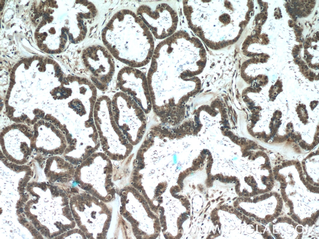 Immunohistochemistry (IHC) staining of human ovary tumor tissue using L1TD1 Polyclonal antibody (21528-1-AP)