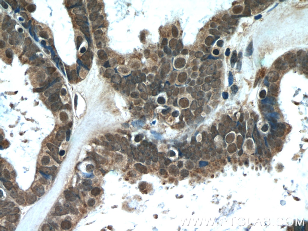 Immunohistochemistry (IHC) staining of human ovary tumor tissue using L1TD1 Polyclonal antibody (21528-1-AP)