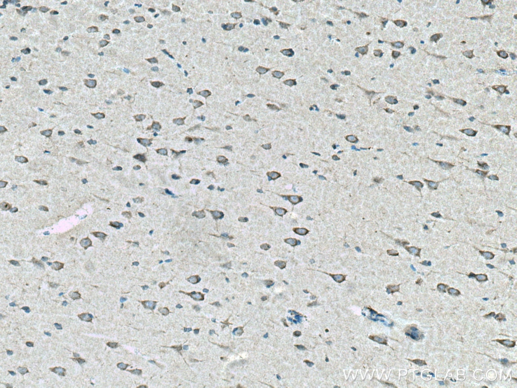 Immunohistochemistry (IHC) staining of human gliomas tissue using L2HGDH Polyclonal antibody (15707-1-AP)