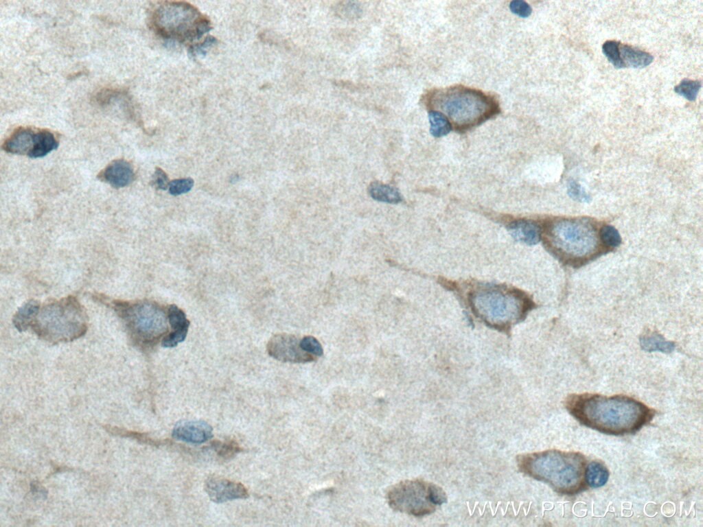 Immunohistochemistry (IHC) staining of human gliomas tissue using L2HGDH Polyclonal antibody (15707-1-AP)