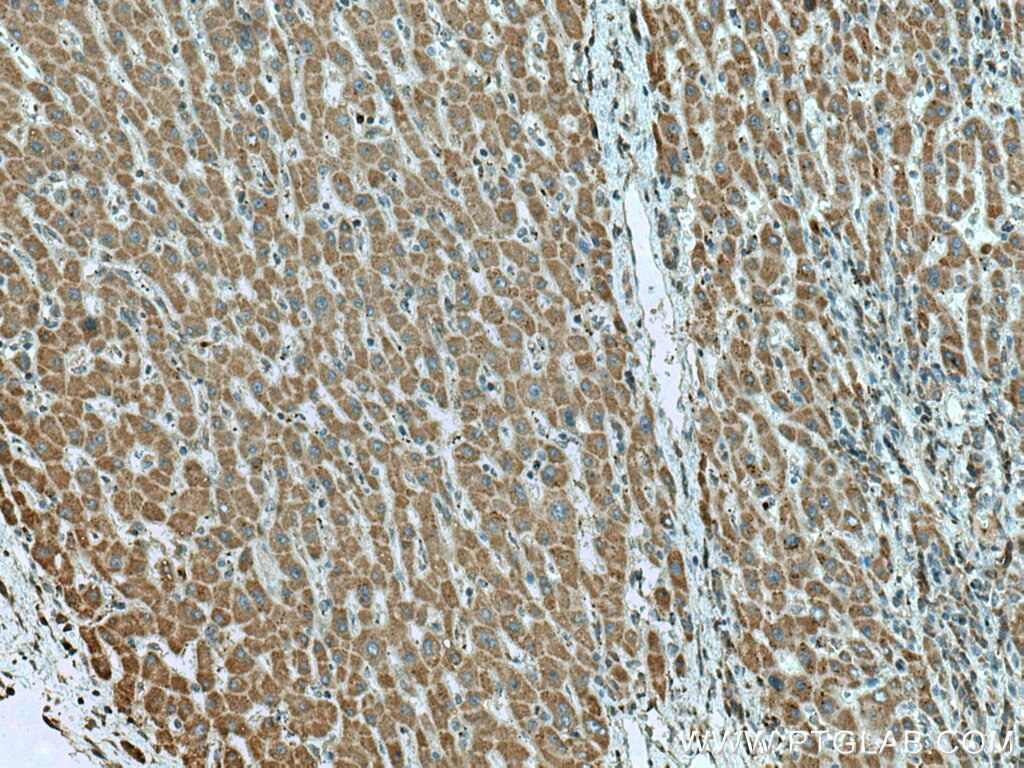 Immunohistochemistry (IHC) staining of human liver cancer tissue using L2HGDH Polyclonal antibody (15707-1-AP)