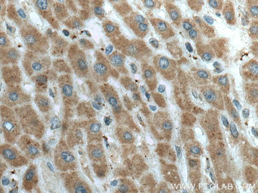 Immunohistochemistry (IHC) staining of human liver cancer tissue using L2HGDH Polyclonal antibody (15707-1-AP)