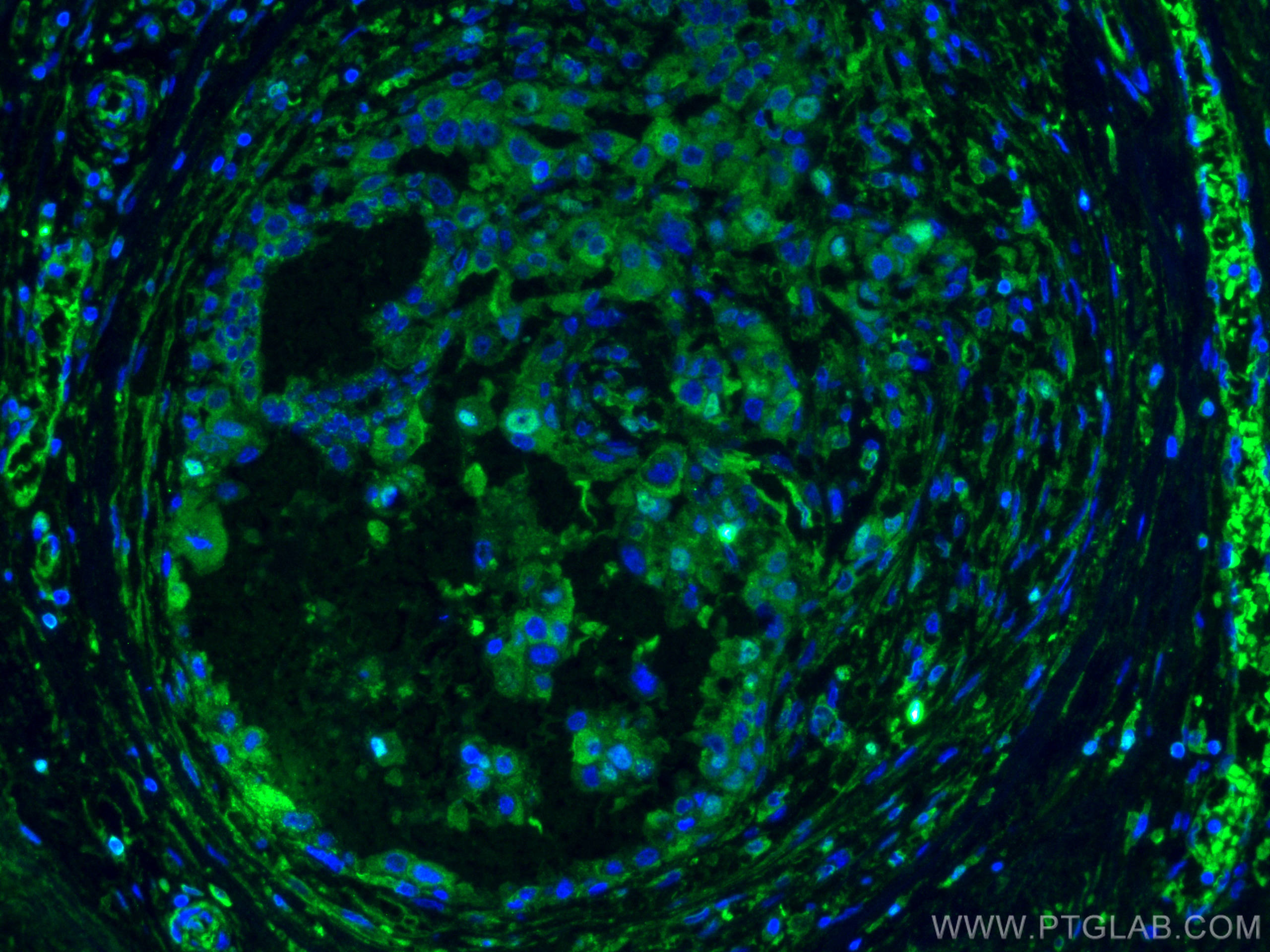 Immunofluorescence (IF) / fluorescent staining of human breast cancer tissue using L2HGDH Monoclonal antibody (66269-1-Ig)