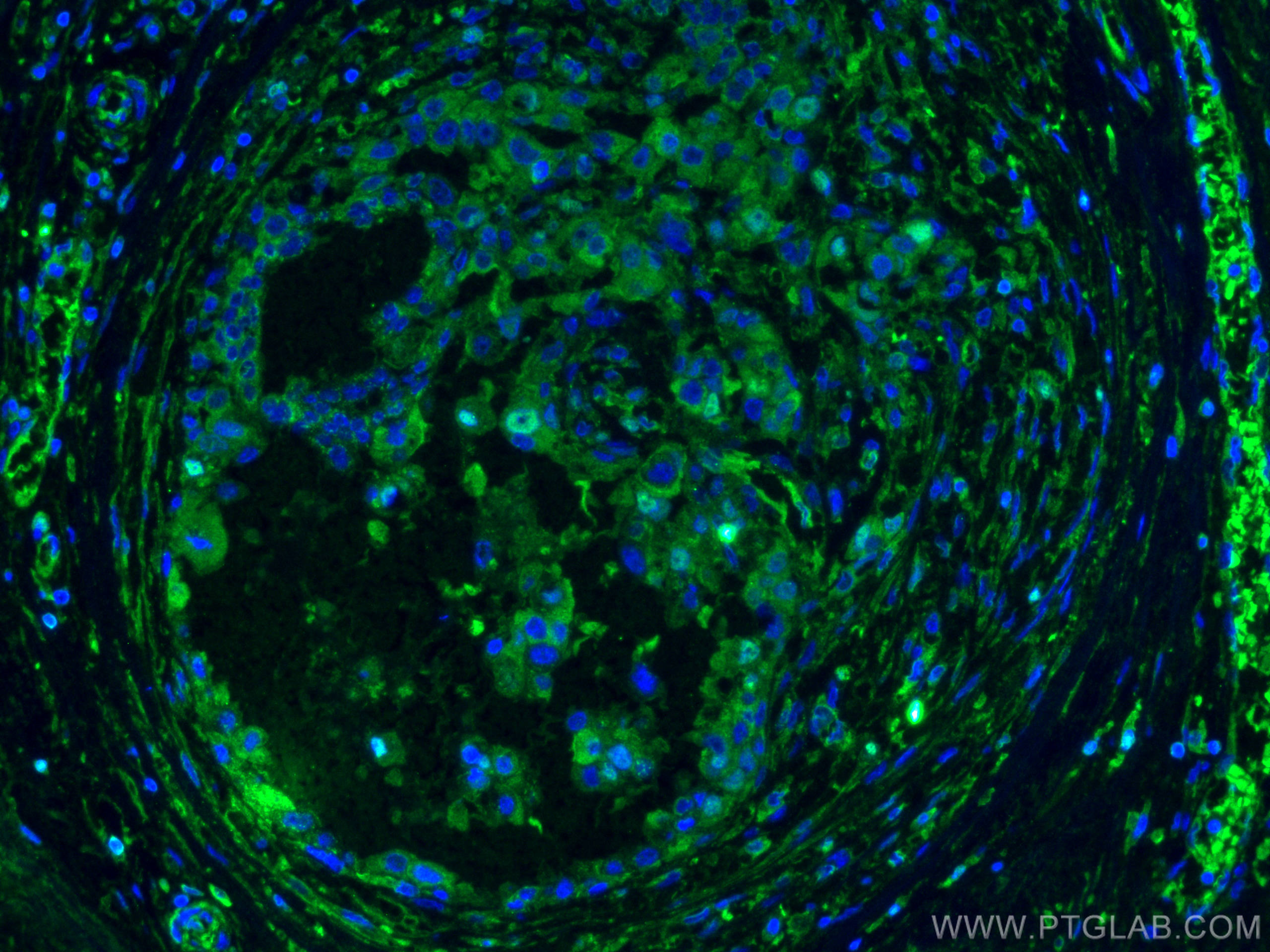 IF Staining of human breast cancer using 66269-1-Ig