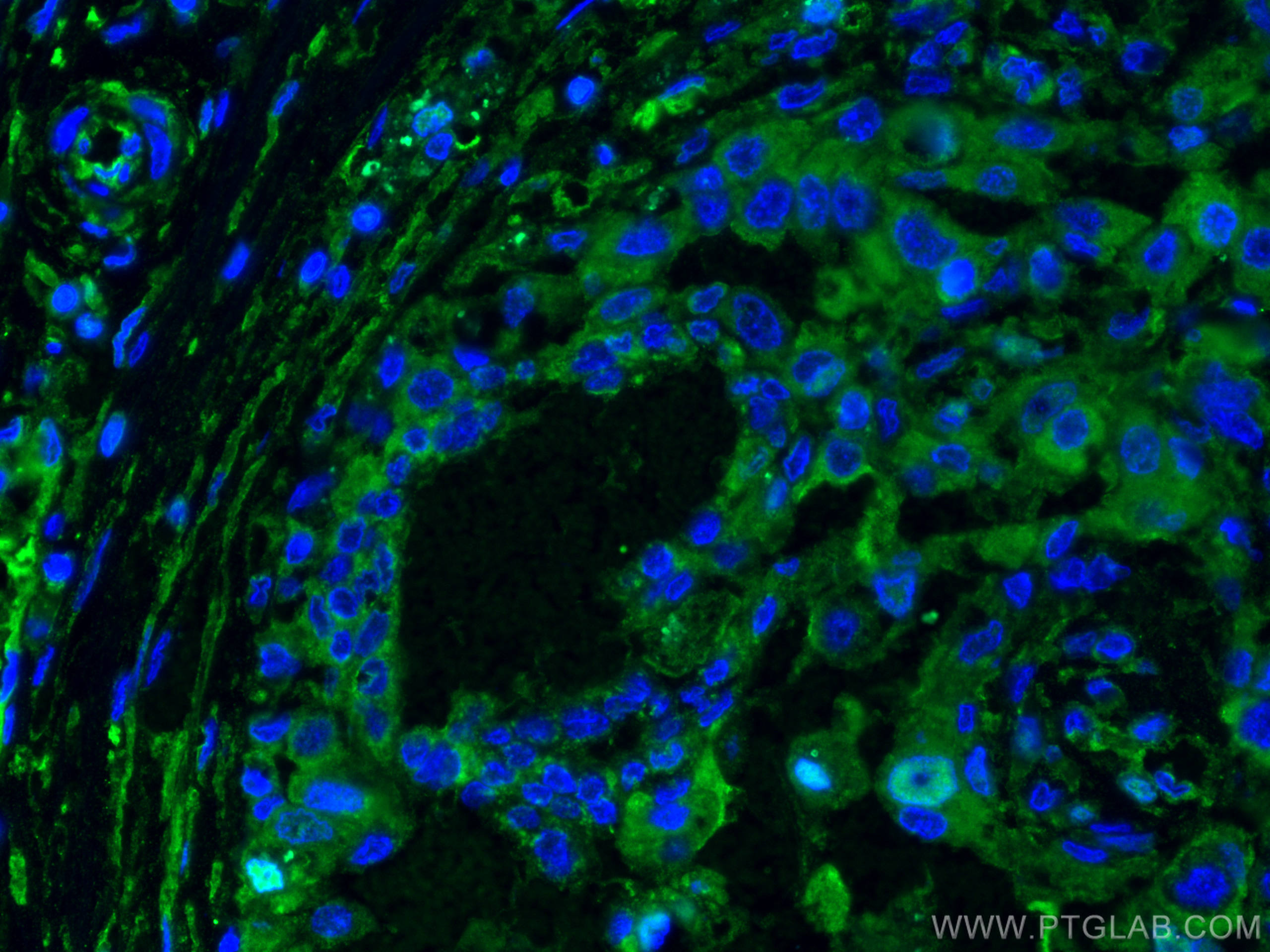 Immunofluorescence (IF) / fluorescent staining of human breast cancer tissue using L2HGDH Monoclonal antibody (66269-1-Ig)
