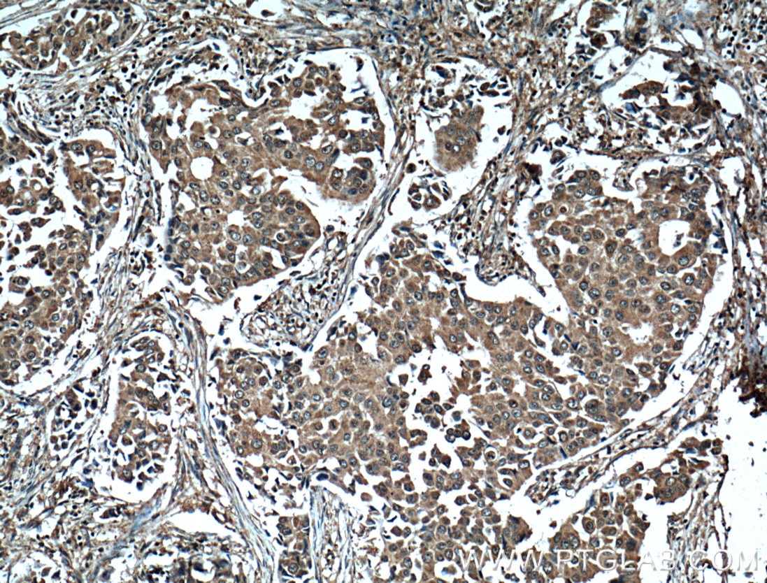 IHC staining of human breast cancer using 66269-1-Ig