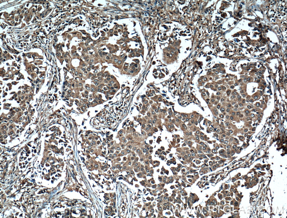 Immunohistochemistry (IHC) staining of human breast cancer tissue using L2HGDH Monoclonal antibody (66269-1-Ig)