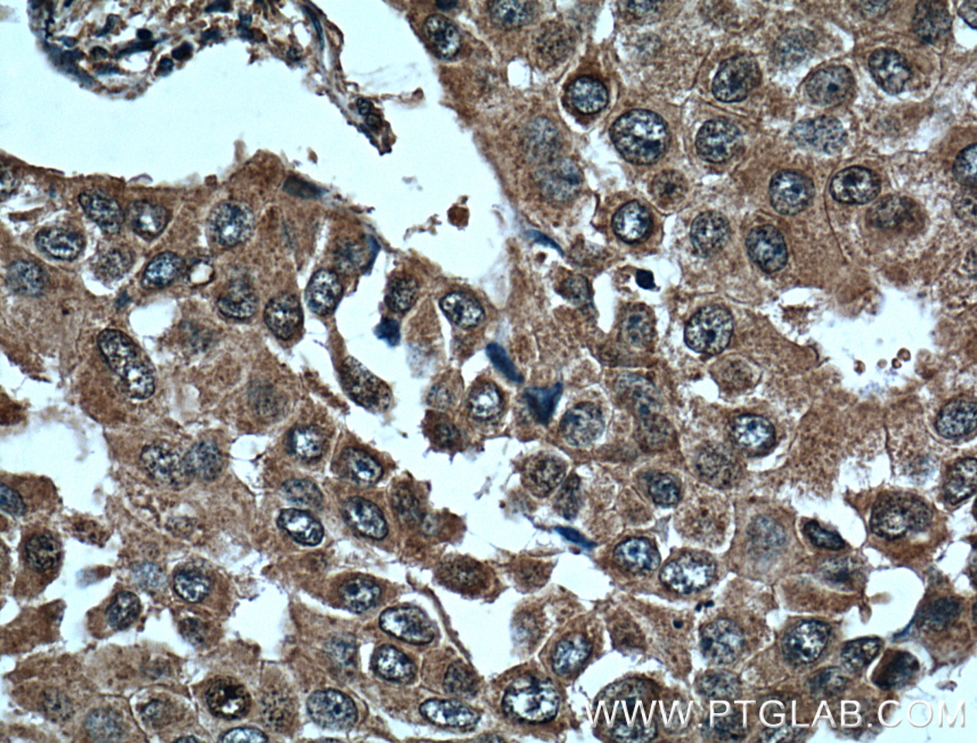 Immunohistochemistry (IHC) staining of human breast cancer tissue using L2HGDH Monoclonal antibody (66269-1-Ig)