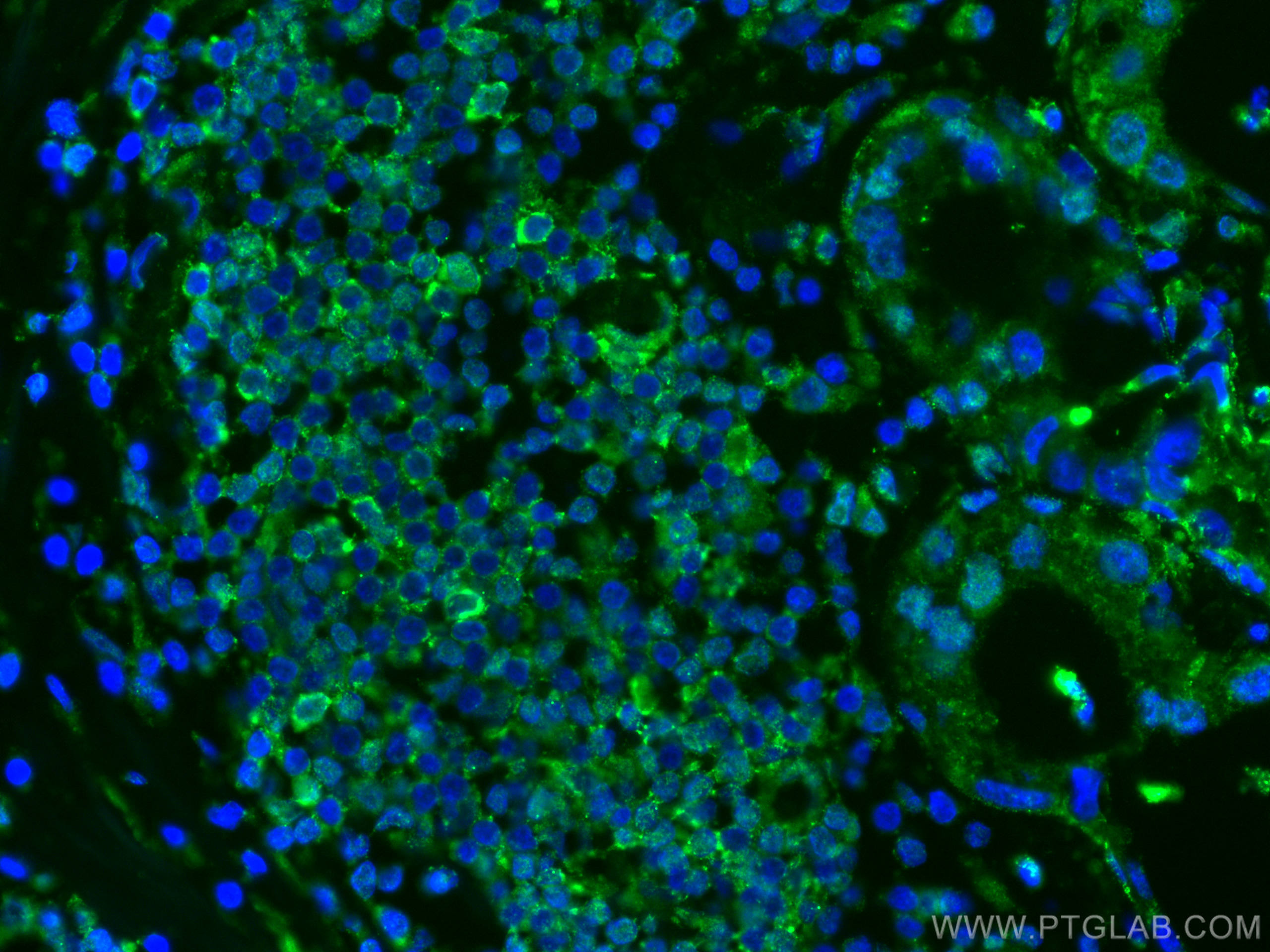 Immunofluorescence (IF) / fluorescent staining of human breast cancer tissue using CoraLite® Plus 488-conjugated L2HGDH Monoclonal an (CL488-66269)