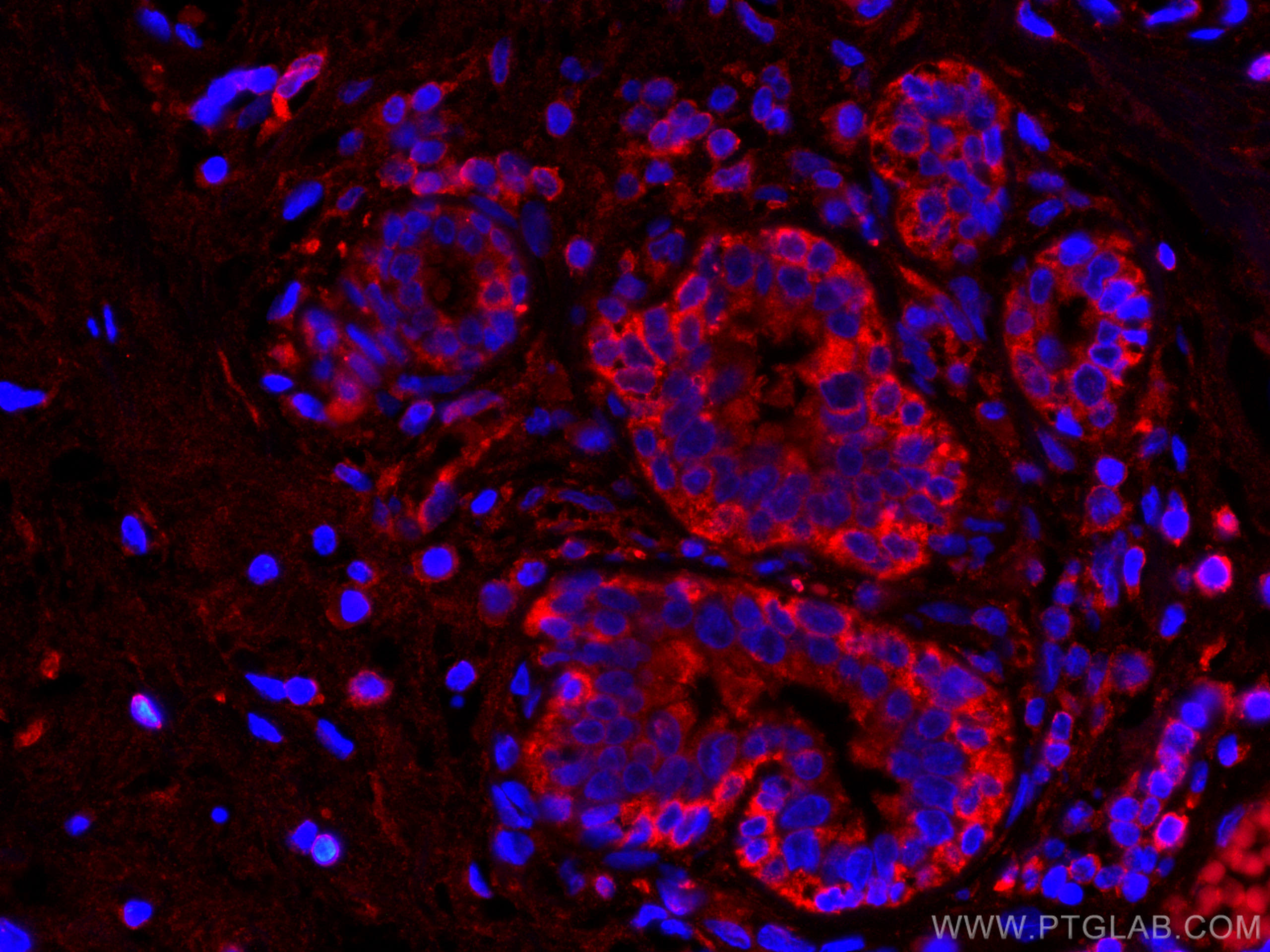 Immunofluorescence (IF) / fluorescent staining of human breast cancer tissue using CoraLite®594-conjugated L2HGDH Monoclonal antibody (CL594-66269)