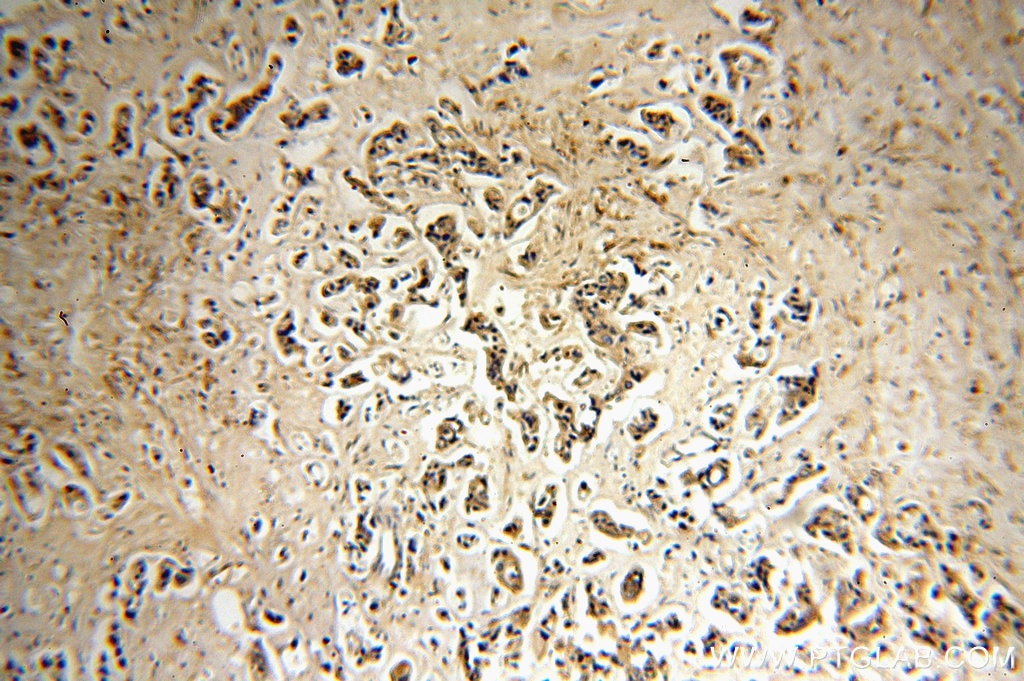 IHC staining of human breast cancer using 18271-1-AP