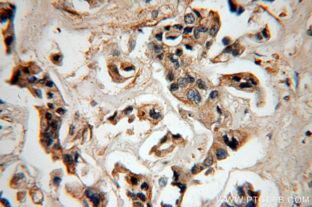 Immunohistochemistry (IHC) staining of human breast cancer tissue using LACRT Polyclonal antibody (18271-1-AP)