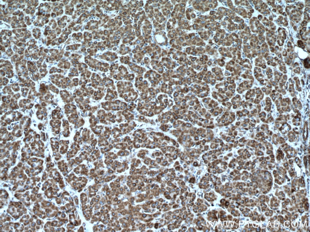 Immunohistochemistry (IHC) staining of human liver cancer tissue using LACTB Polyclonal antibody (18195-1-AP)