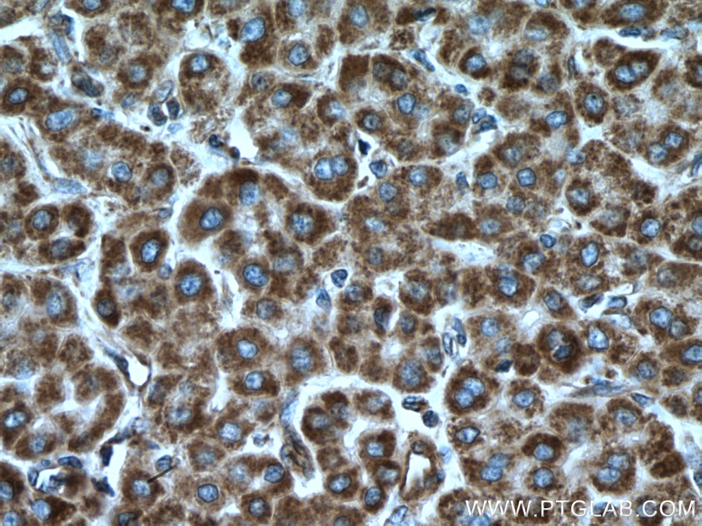 Immunohistochemistry (IHC) staining of human liver cancer tissue using LACTB Polyclonal antibody (18195-1-AP)