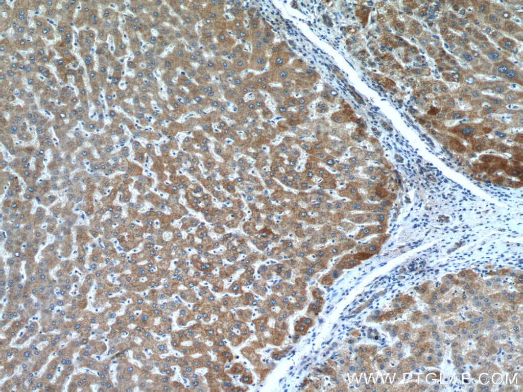 Immunohistochemistry (IHC) staining of human liver cancer tissue using LACTB Polyclonal antibody (18195-1-AP)