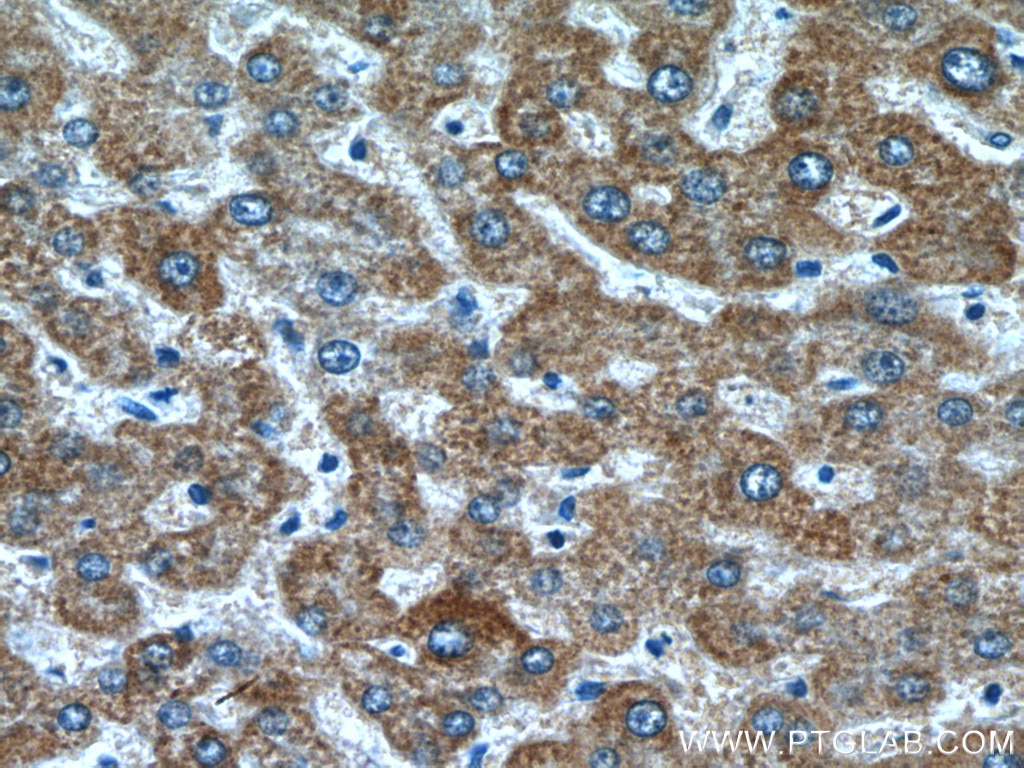 Immunohistochemistry (IHC) staining of human liver cancer tissue using LACTB Polyclonal antibody (18195-1-AP)