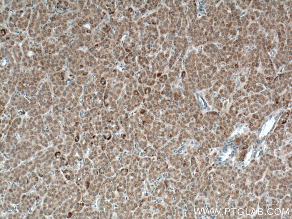 IHC staining of human liver cancer using 66785-1-Ig