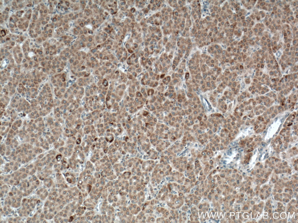 Immunohistochemistry (IHC) staining of human liver cancer tissue using LACTB Monoclonal antibody (66785-1-Ig)