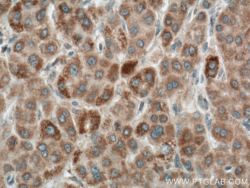 Immunohistochemistry (IHC) staining of human liver cancer tissue using LACTB Monoclonal antibody (66785-1-Ig)