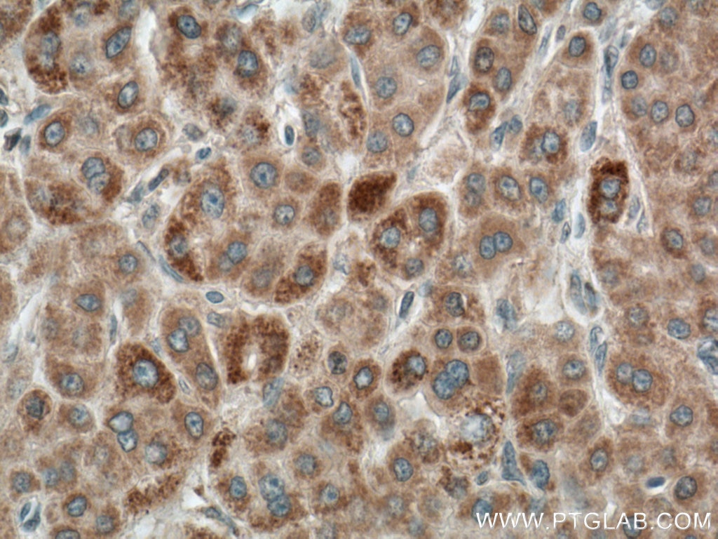 IHC staining of human liver cancer using 66785-1-Ig