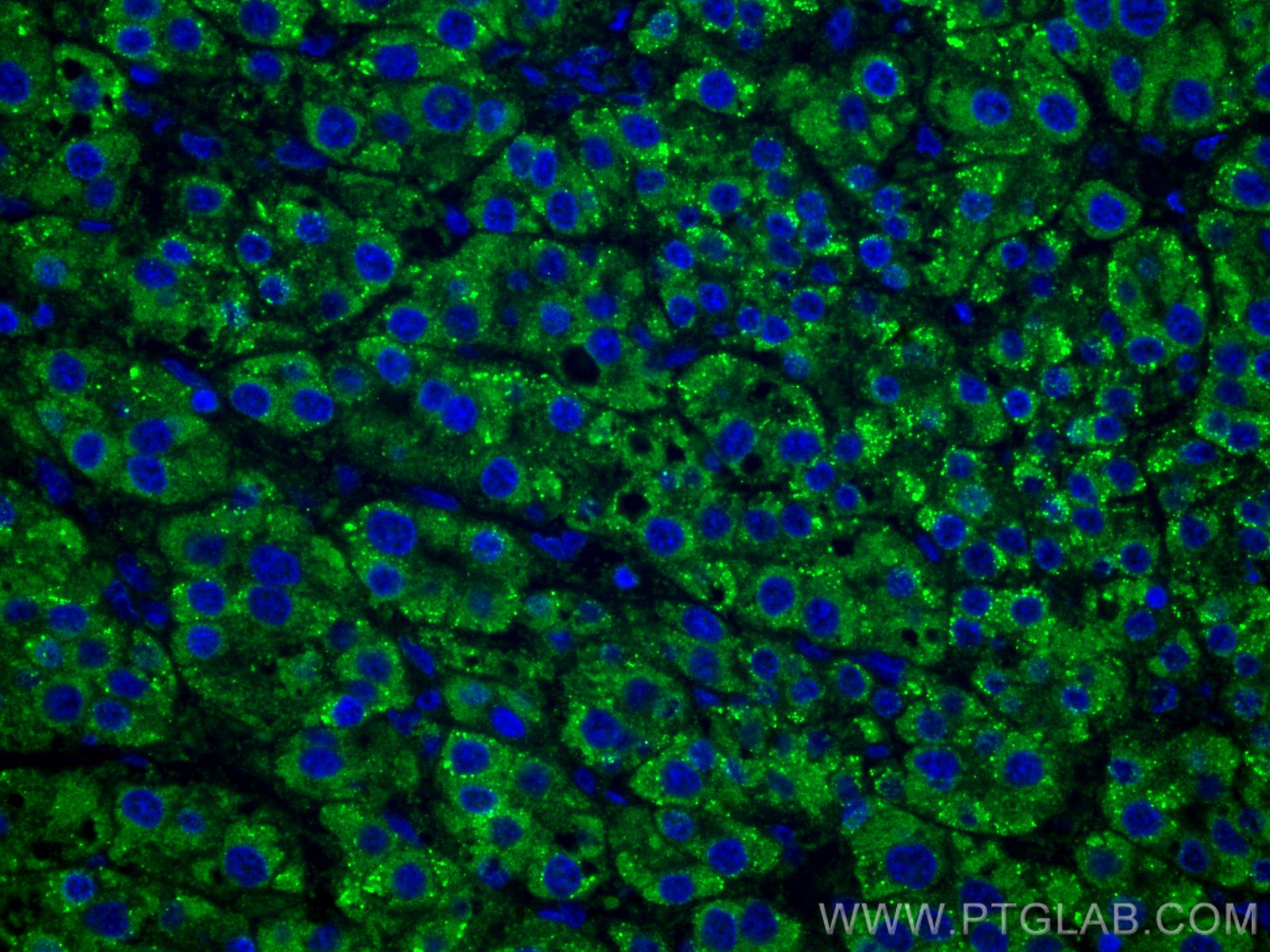 Immunofluorescence (IF) / fluorescent staining of human liver cancer tissue using LACTB2 Monoclonal antibody (67399-1-Ig)