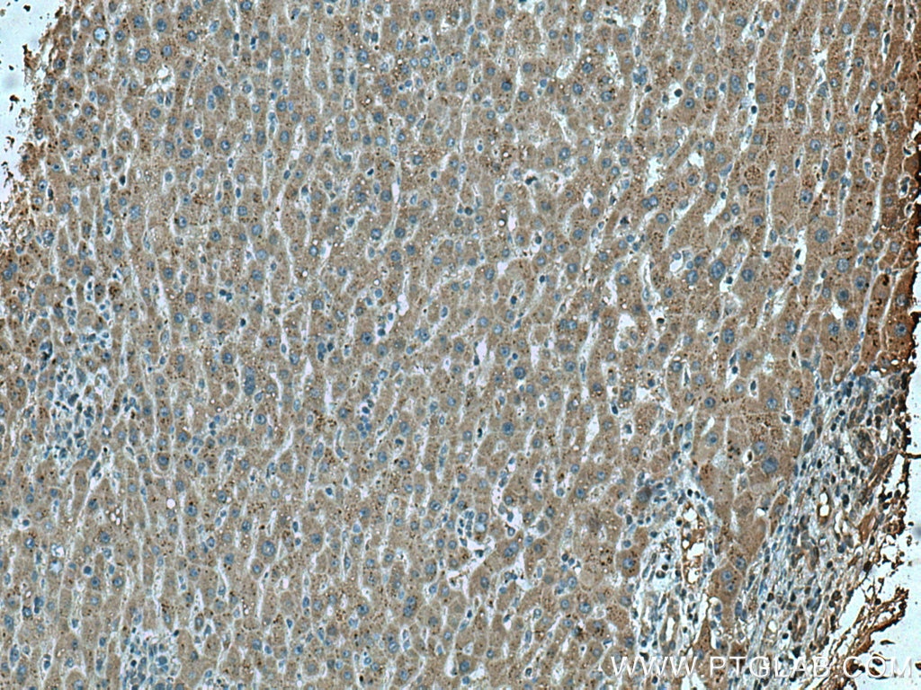 IHC staining of human liver cancer using 67399-1-Ig