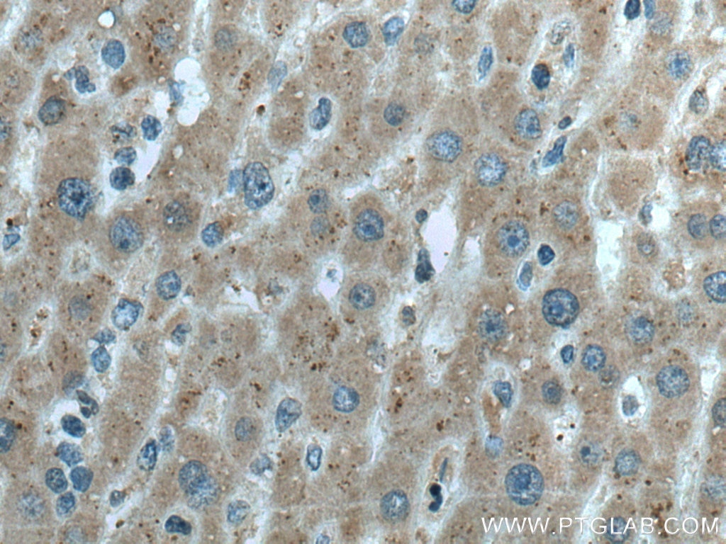 Immunohistochemistry (IHC) staining of human liver cancer tissue using LACTB2 Monoclonal antibody (67399-1-Ig)