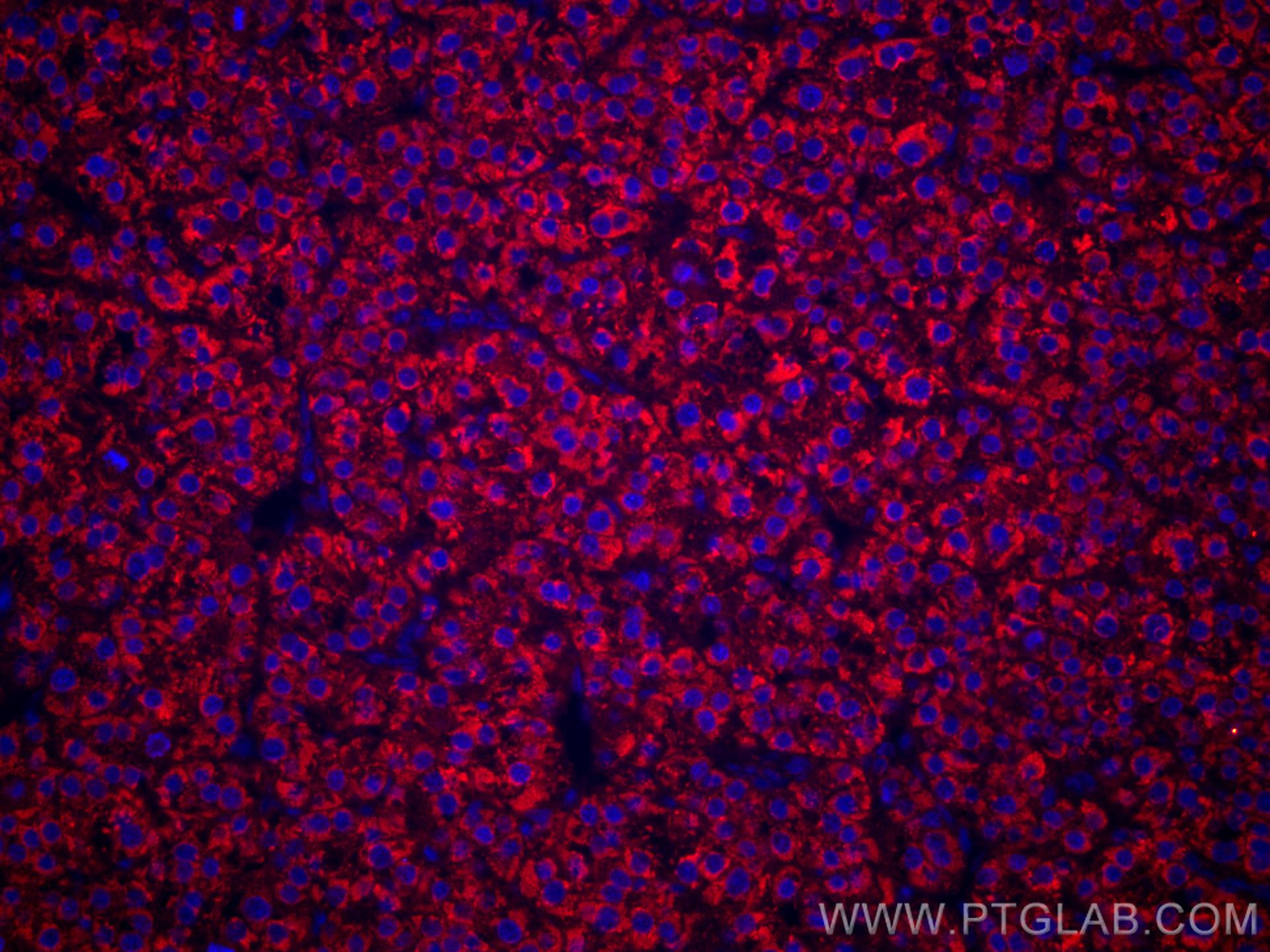 Immunofluorescence (IF) / fluorescent staining of human liver cancer tissue using CoraLite®594-conjugated LACTB2 Monoclonal antibody (CL594-67399)
