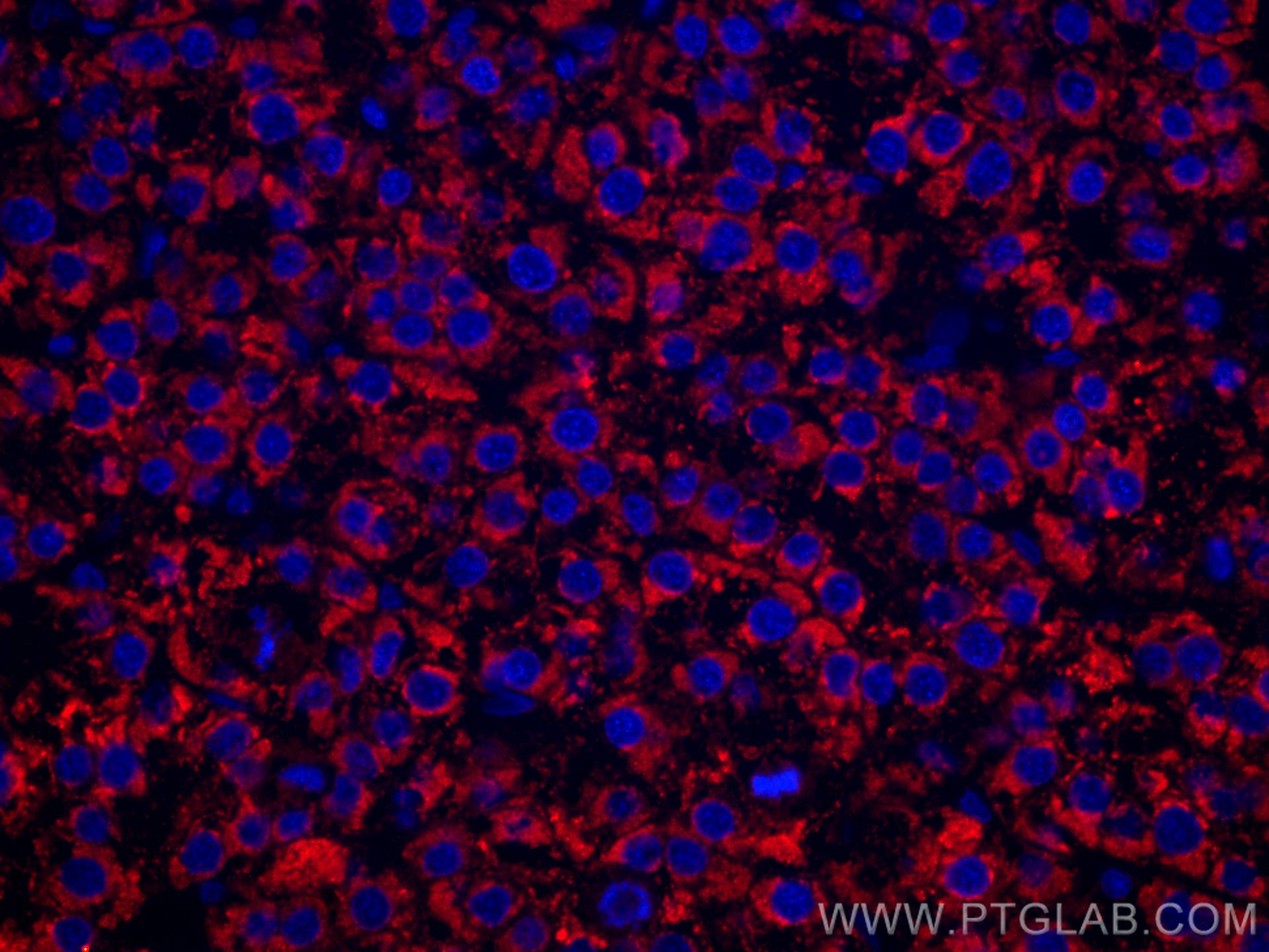 Immunofluorescence (IF) / fluorescent staining of human liver cancer tissue using CoraLite®594-conjugated LACTB2 Monoclonal antibody (CL594-67399)