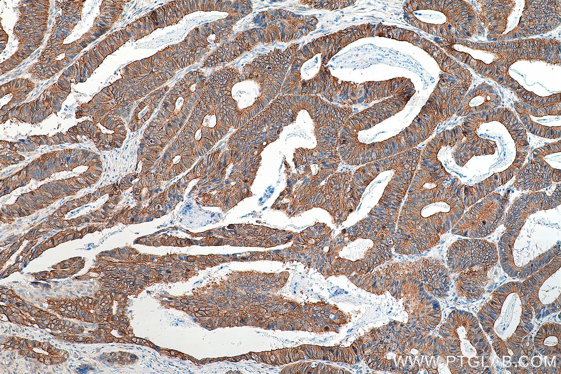 IHC staining of human colon cancer using 16136-1-AP