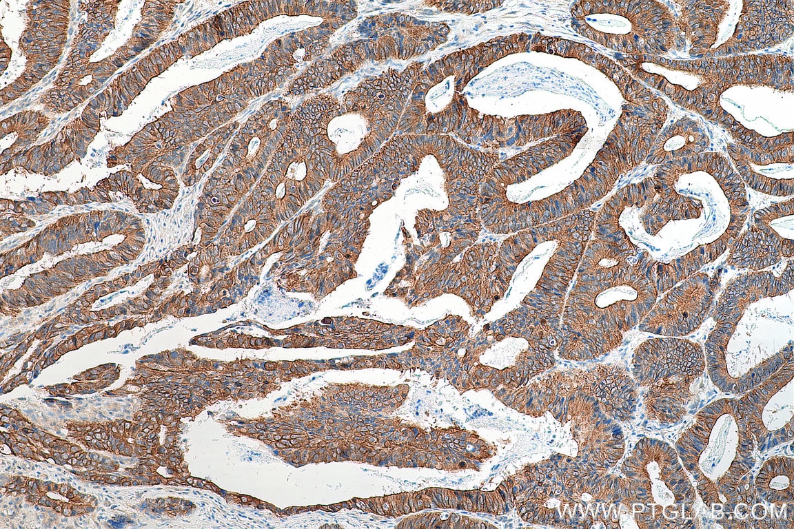 Immunohistochemistry (IHC) staining of human colon cancer tissue using LAD1 Polyclonal antibody (16136-1-AP)