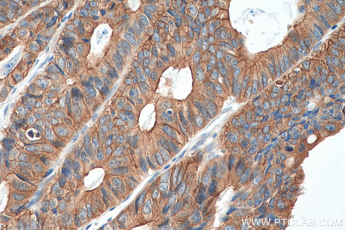 Immunohistochemistry (IHC) staining of human colon cancer tissue using LAD1 Polyclonal antibody (16136-1-AP)