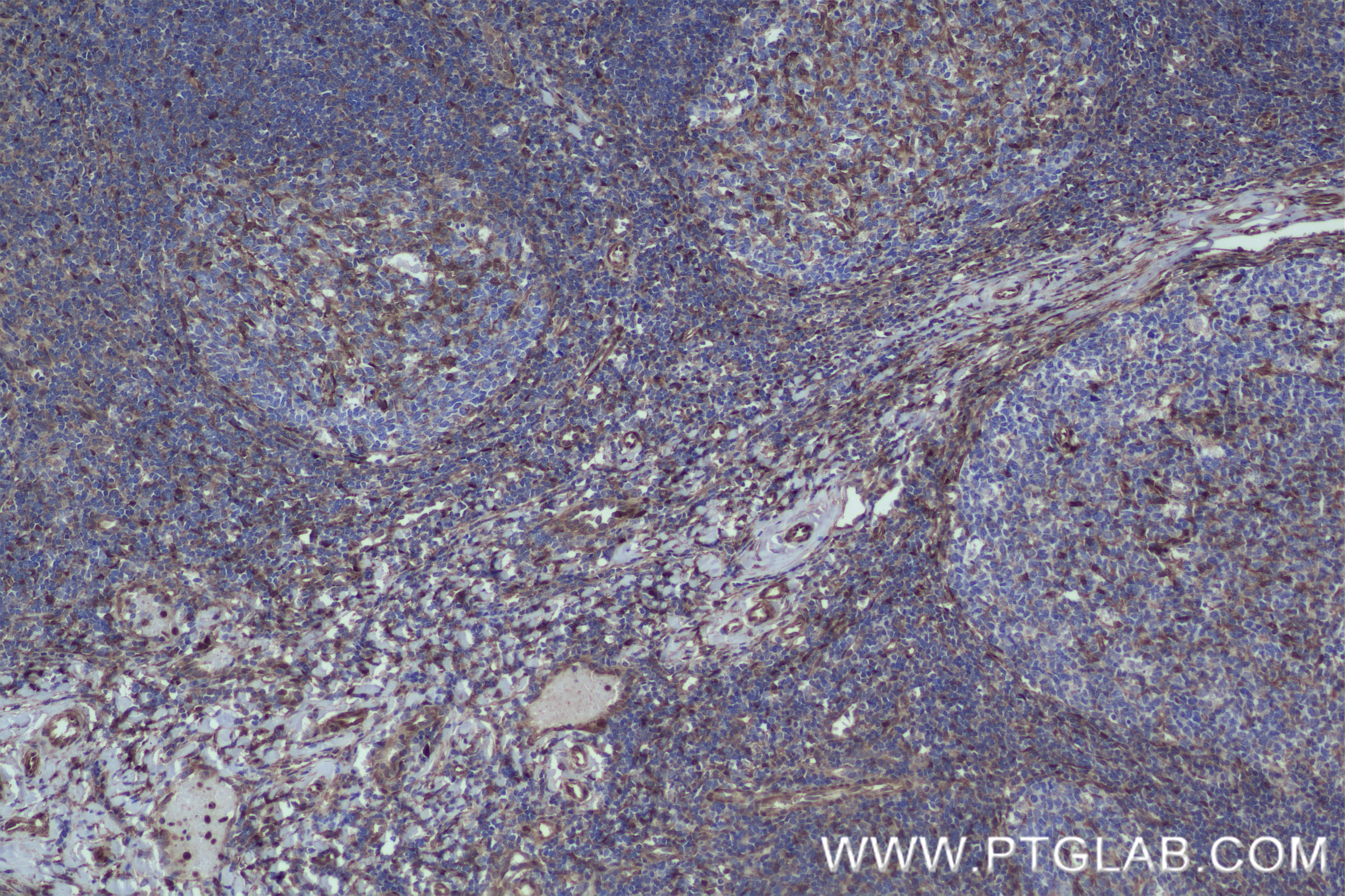 Immunohistochemistry (IHC) staining of human tonsillitis tissue using LAG-3/CD223 Recombinant antibody (80855-7-RR)